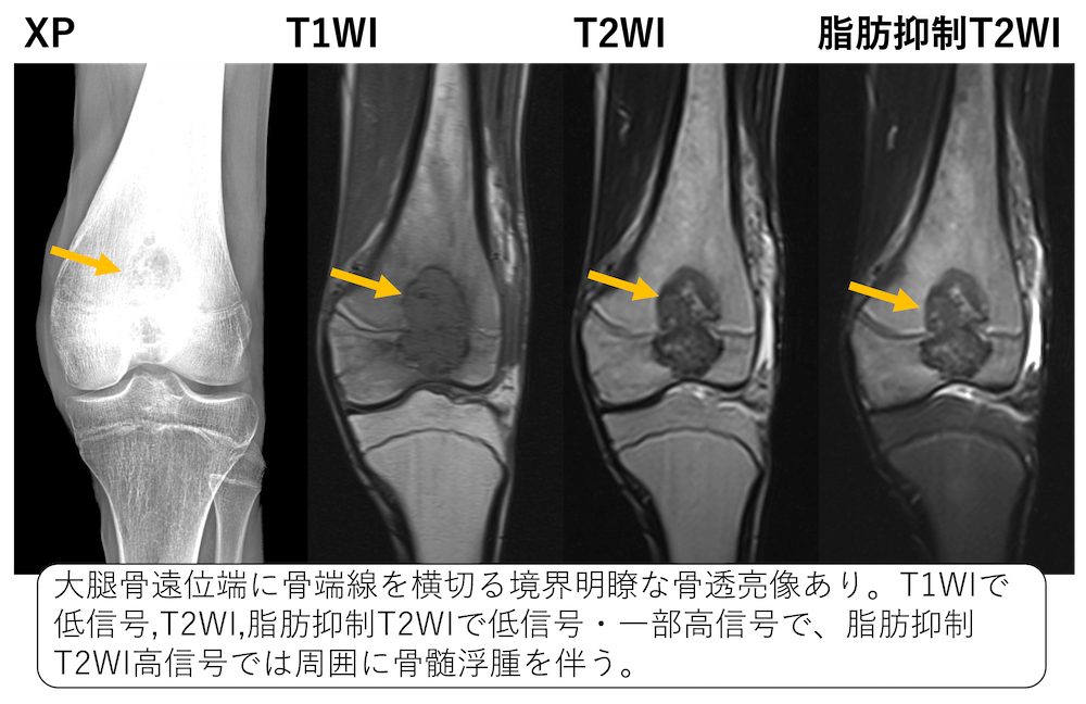 軟骨芽細胞腫のCT、MRI画像診断(骨端にできる骨腫瘍)